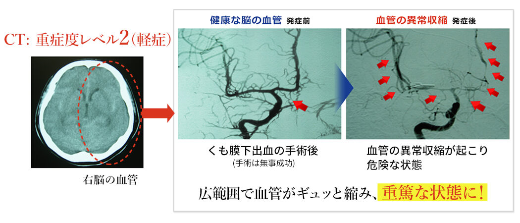 血管の異常収縮により危険な状態になった脳