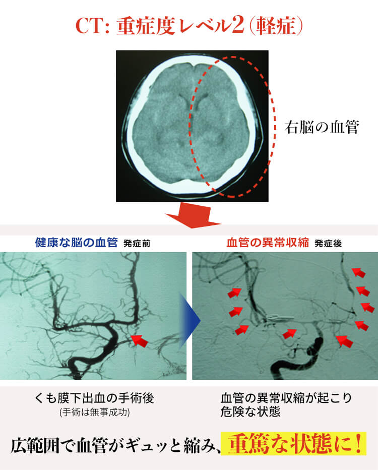 血管の異常収縮により危険な状態になった脳